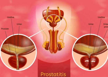 prostatitida